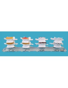 Degeneración de las Vertebras (modelo con 4 fases de daños vertebral)