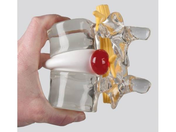 Simulador Hernia Discal